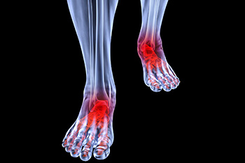 Arthritic foot and ankle care treatment, foot arthritis treatment in the San Antonio, TX 78224, Uvalde, TX 78801 and Jourdanton, TX 78026 areas